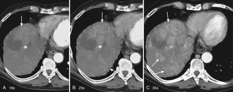 Figure 35-7, Improved detection of hepatocellular carcinoma in the late arterial phase. Serial images obtained at 18 seconds (A), 25 seconds (B), and 35 seconds (C) after initiation of contrast injection. Although arterially enhancing lesions are seen on images A and B, better enhancement and more lesions (arrows) are evident on the late arterial phase image (C).