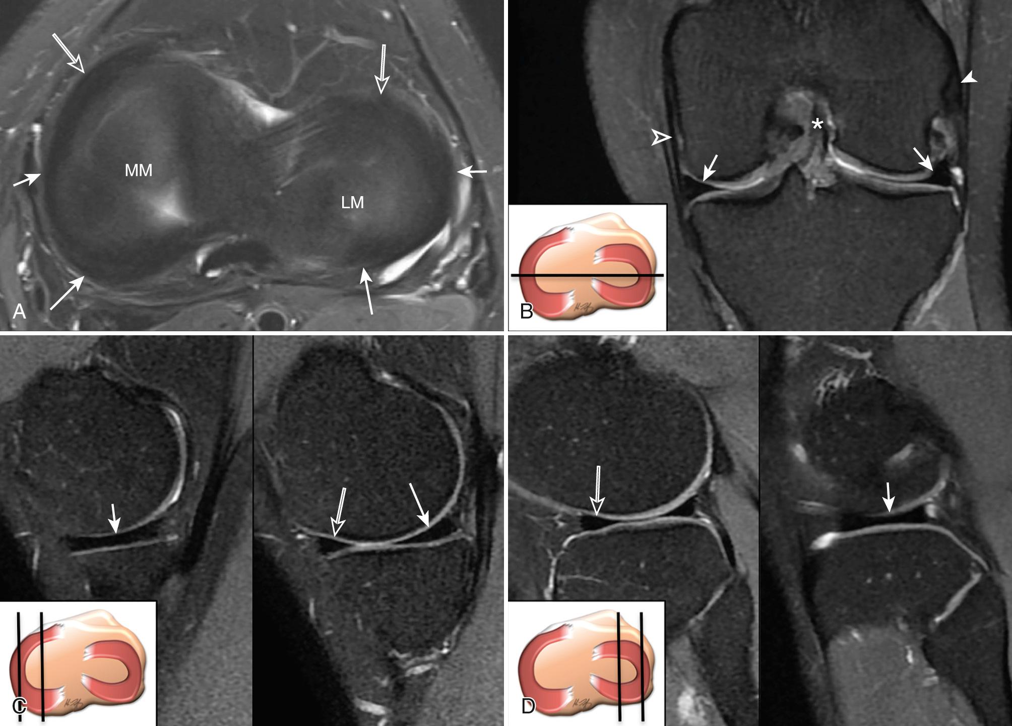 FIG 7.2, Axial (A), coronal (B), and sagittal (C and D) proton density (PD) fat-saturated (FS) MR images show the normal MR anatomy of the lateral and medial meniscus. Normal semilunar morphology of the menisci is observed on the axial MR image (A). The medial meniscus (MM) has a more open C-shape configuration than the lateral meniscus (LM). Each meniscus is divided in three portions: anterior horn (open arrows) , body (thick arrows) , and posterior horn (thin arrows) . The body of the medial and lateral meniscus (thick arrows) appears as a wedged, hypointense structure on coronal MR images (B), whereas the anterior (open arrows) and posterior (thin arrows) horns of the medial (C) and lateral (D) meniscus have a wedged configuration on sagittal MR images. The body of the menisci take on a more bow tie configuration when imaged parallel to its longitudinal axis ( thick arrows in C and D). Open arrowhead indicates the medial collateral ligament; white arrowhead indicates lateral collateral ligament.