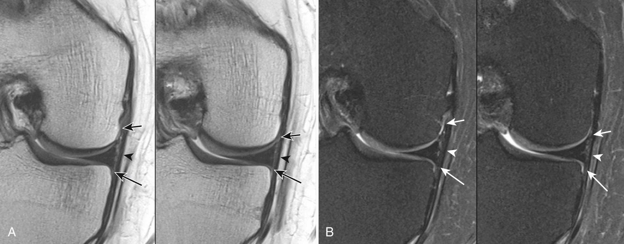 FIG 7.4, Normal Anatomy of the Medial Supporting Structures