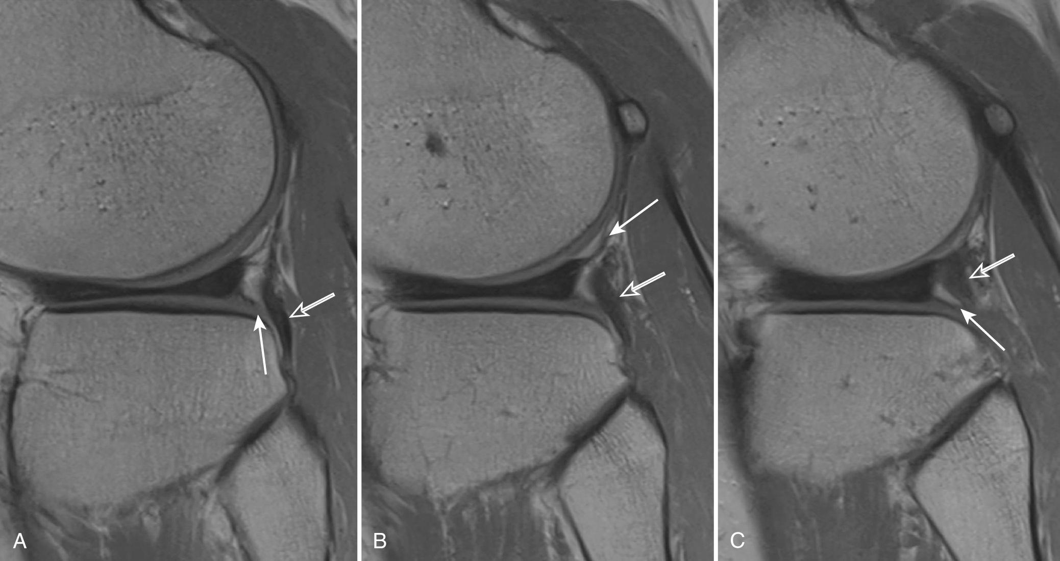 FIG 7.5, Normal Anatomy of the Lateral Supporting Structures