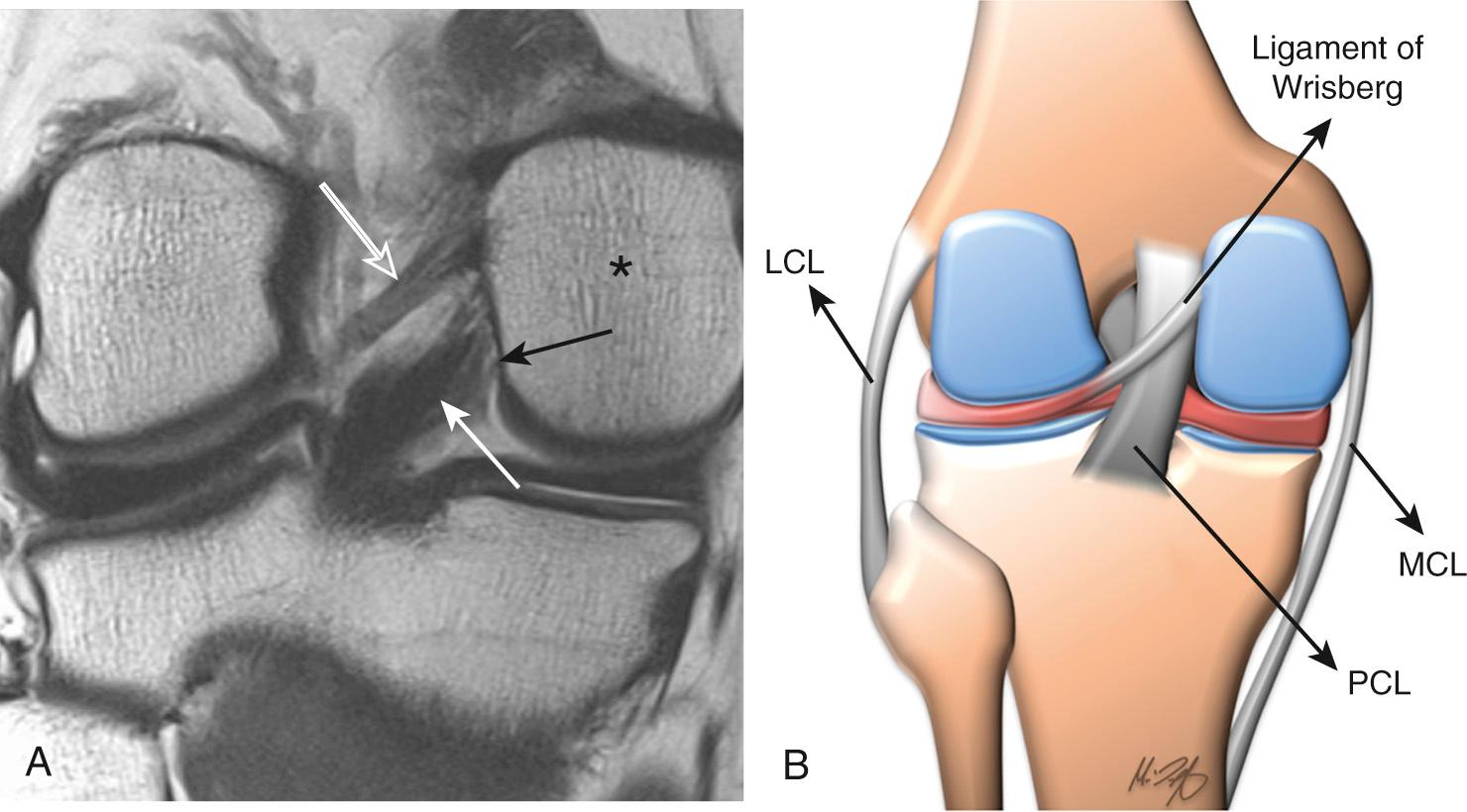 FIG 7.6, Normal Anatomy of the Meniscofemoral Ligaments