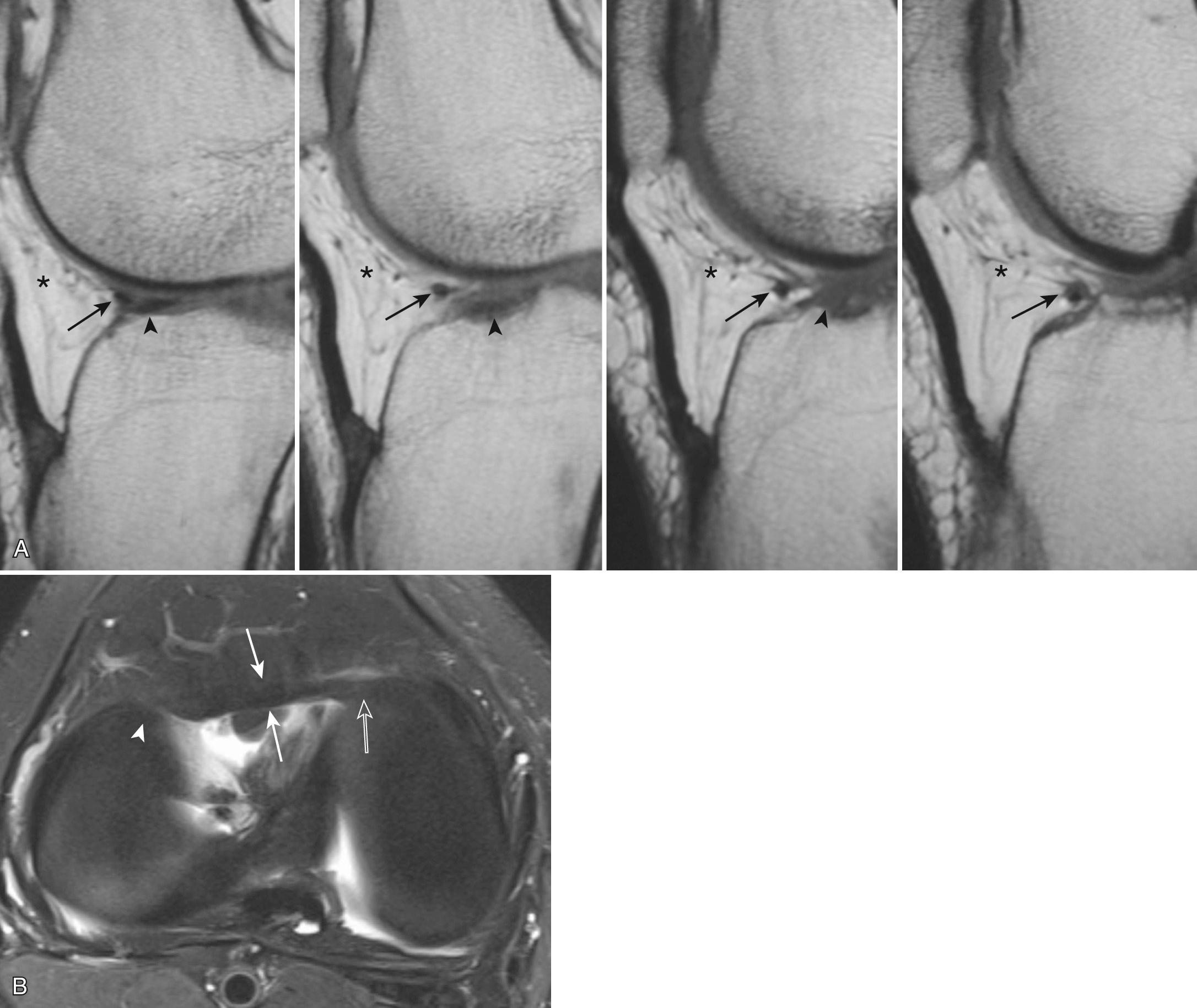 FIG 7.8, Anterior Transverse Meniscal Ligament