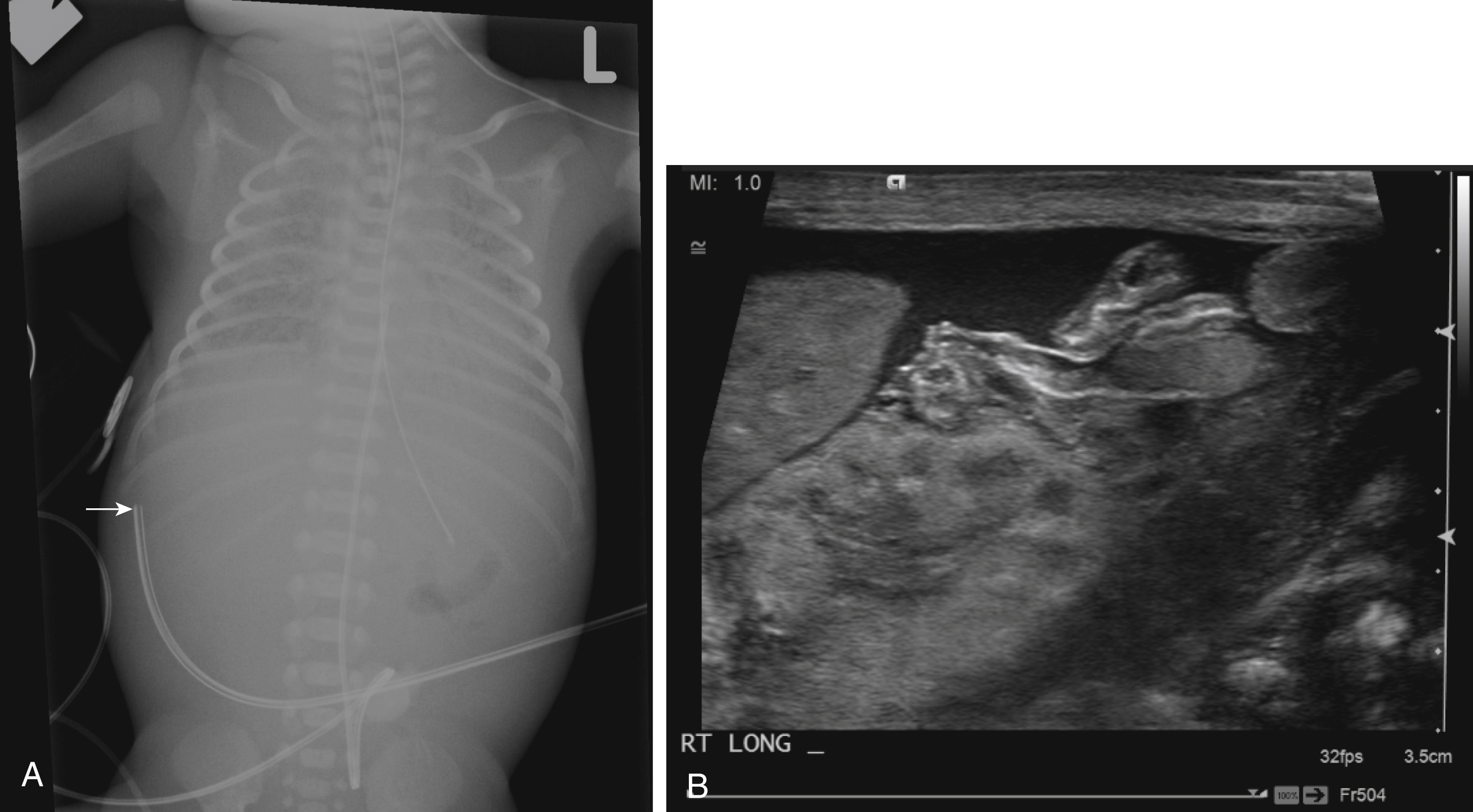 Fig. 18.4, Umbilical venous catheter malposition.