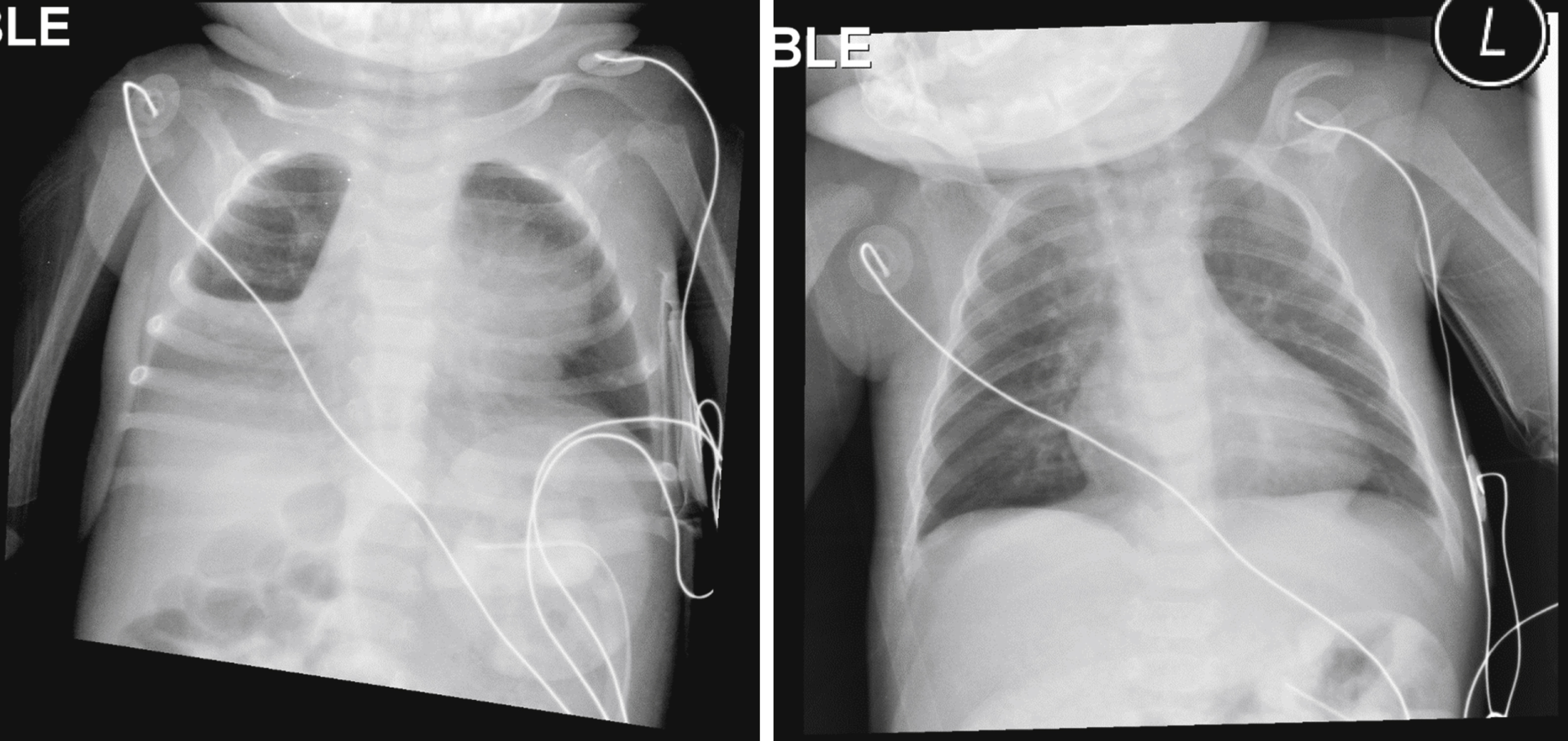 Fig. 19.1, Effects of apical lordotic technique.