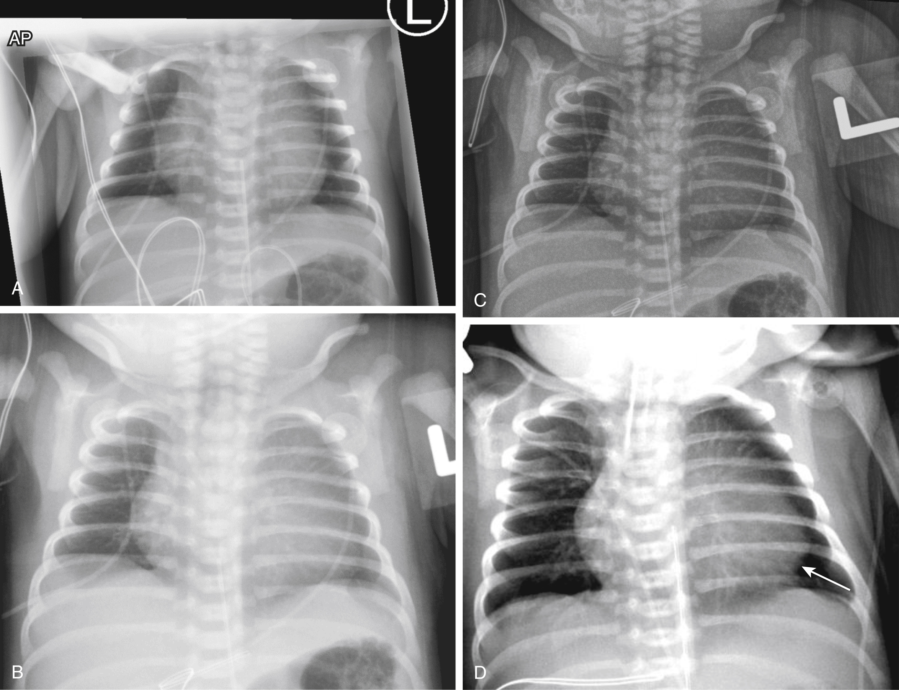 Fig. 19.2, Effect of rotation on the appearance of the cardiothymic shadow.