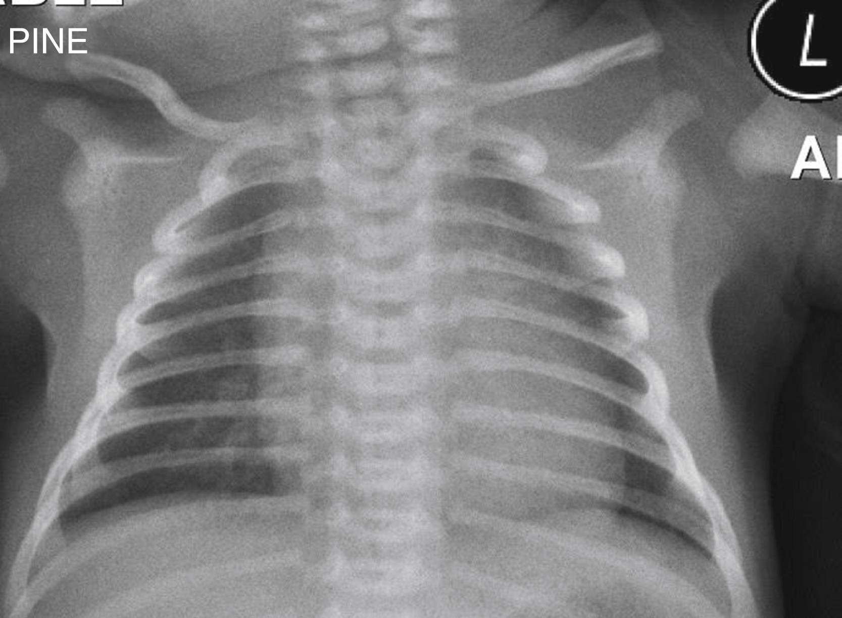 Fig. 19.4, Normal chest radiograph in a term infant.