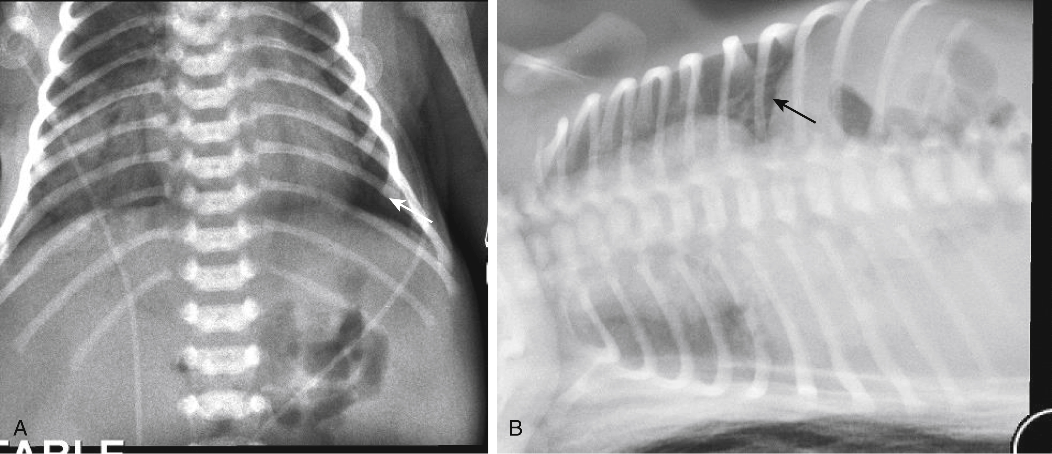 Fig. 19.5, Spurious pneumothorax.