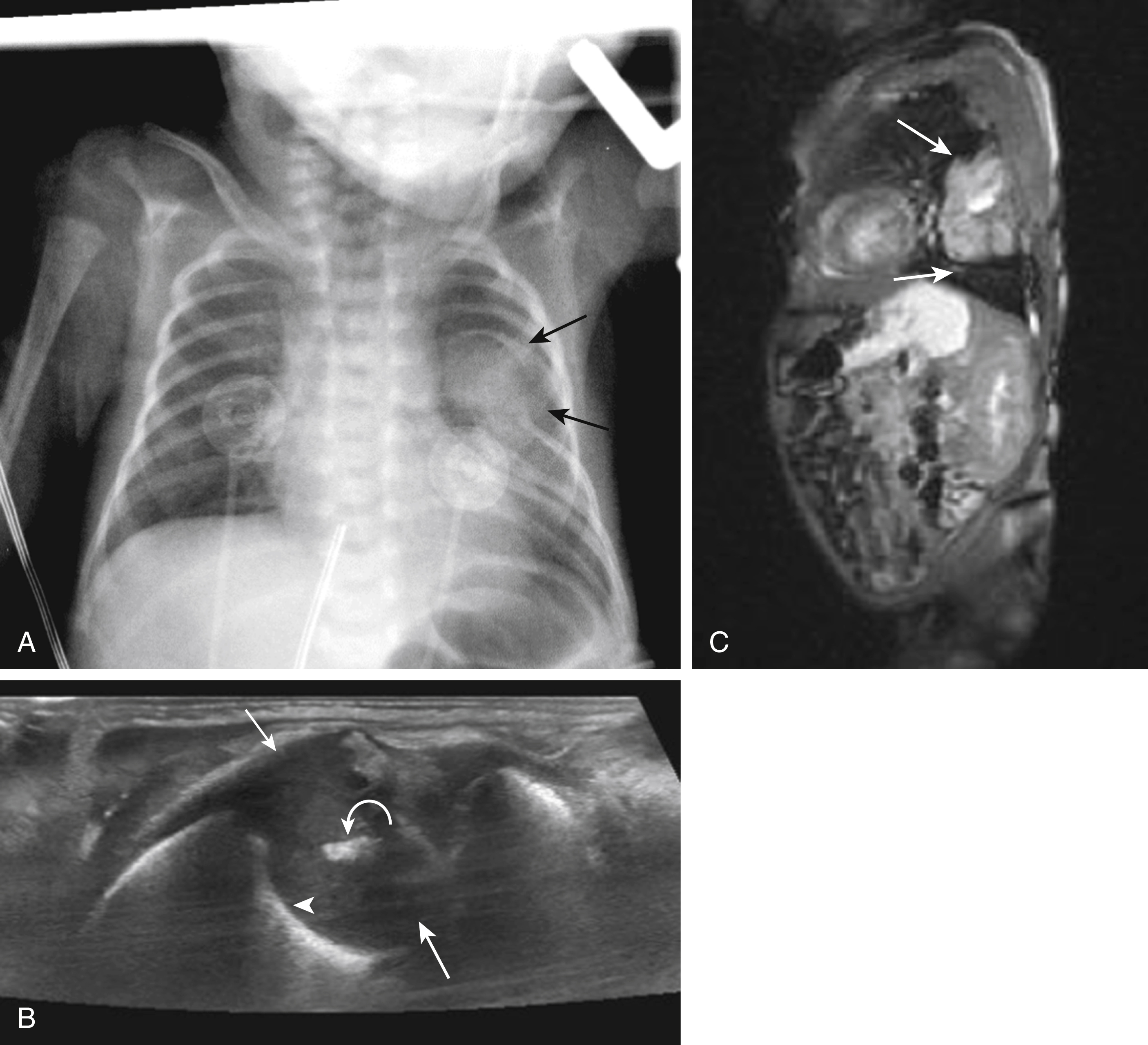 Fig. 19.6, Mesenchymal hamartoma of the chest wall.