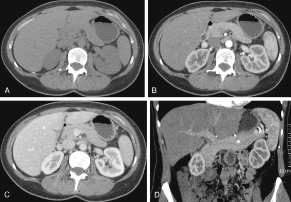 Figure 45-1, Computed tomography (CT) anatomy of the pancreas. Precontrast axial CT image of the pancreas (A) shows normal glandular thickness. On the pancreatic phase of the dynamic study (B), pancreatic parenchyma shows intense, homogeneous enhancement similar to the renal cortex, with washout during the portal venous phase (C). On coronal curved reformatted image (D), the whole main pancreatic duct can be depicted.