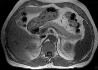 Figure 45-2, Normal magnetic resonance imaging anatomy of the pancreas: T1-weighted image. Axial T1-weighted gradient-echo image (repetition time/echo time [TR/TE]: 145/4.2 ms) shows pancreatic parenchyma of normal thickness. The intensity of pancreatic parenchyma is higher compared with that of the liver and spleen.