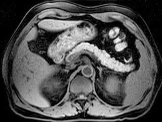 Figure 45-3, Normal magnetic resonance imaging anatomy of the pancreas: fat-saturated T1-weighted image. The application of a fat-saturating pulse eliminates the high signal intensity fat on T1-weighted images, improving in this manner the dynamic range of the image.