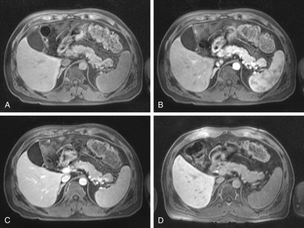 Figure 45-4, Normal magnetic resonance imaging anatomy of the pancreas: dynamic imaging during intravenous administration of gadolinium chelates. A, Axial T1-weighted gradient echo image before the administration of gadolinium chelates. B, Axial T1-weighted gradient echo images during the arterial (B), portal venous (C), and delayed phase (D) of the dynamic study. Of note is the marked signal intensity enhancement of the pancreatic parenchyma during the arterial/pancreatic phase, reflecting its glandular architecture.