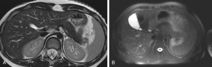 Figure 45-5, Normal magnetic resonance imaging of the pancreas: T2-weighted imaging. A, Axial T2-weighted rapid acquisition with relaxation enhancement (RARE) image (repetition time/echo time [TR/TE]: 3500/80 ms) of the pancreas shows the signal intensity of the pancreatic gland is lower compared with that of the liver and the spleen. B, The signal intensity changes are better appreciated on the fat-saturated half-Fourier single-shot turbo spin echo (HASTE) T2-weighted image (TR/TE: ∞/90 ms).