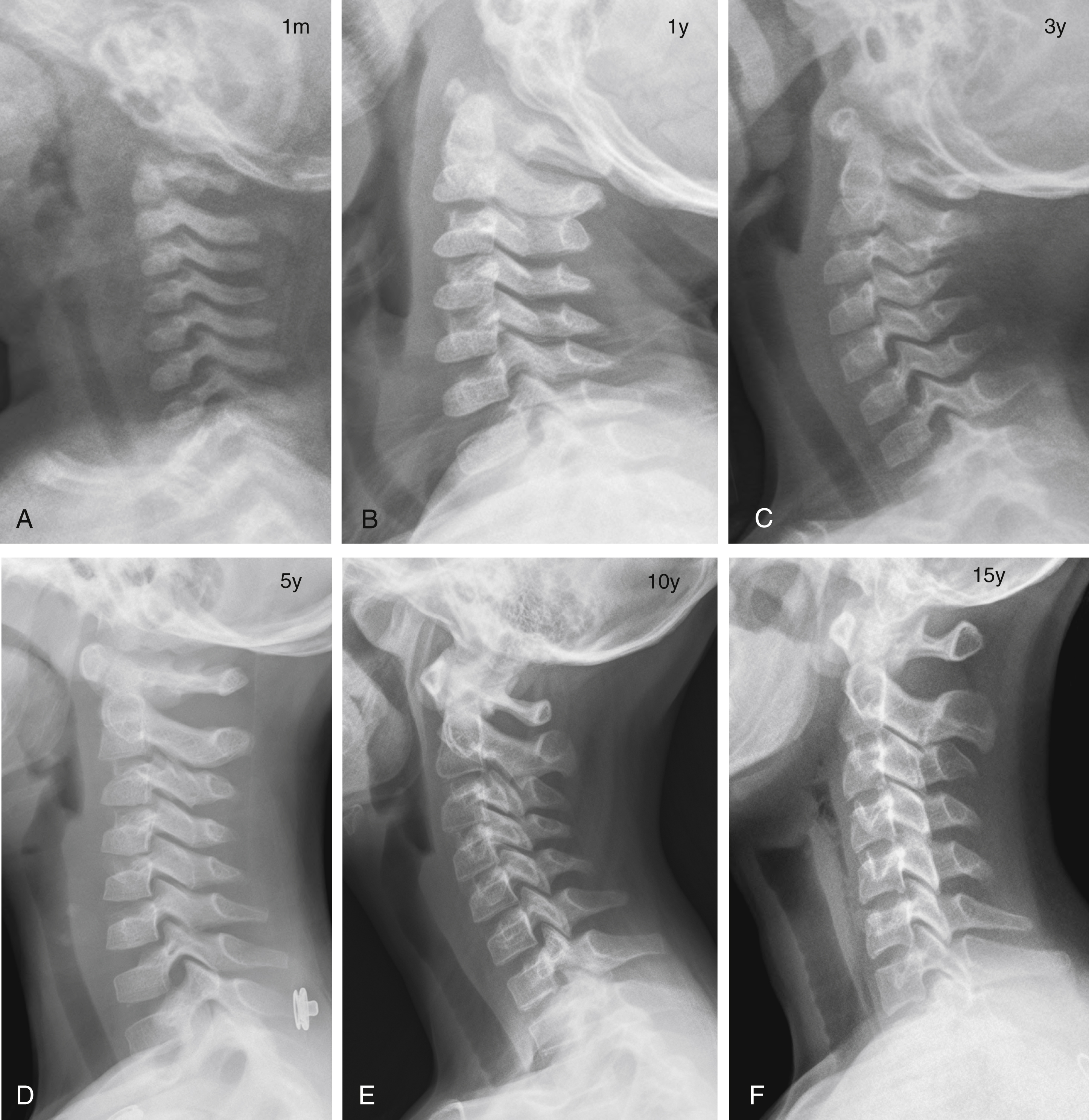 Fig. 28.1, Lateral radiographs of the cervical spine at (A) 1 month, (B) 1 year, (C) 3 years, (D) 5 years, (E) 10 years, and (F) 15 years of age. Vertebral body shape changes from oval shape in infancy, mild anterior wedge shape in the young child, and rectangular or square shape in the older child and adolescent. In the young child (A–C), there is uncovered appearance of the facets, overriding C1 on C2, and underdeveloped, upward orientation of the spinous processes. m , months; y , years.