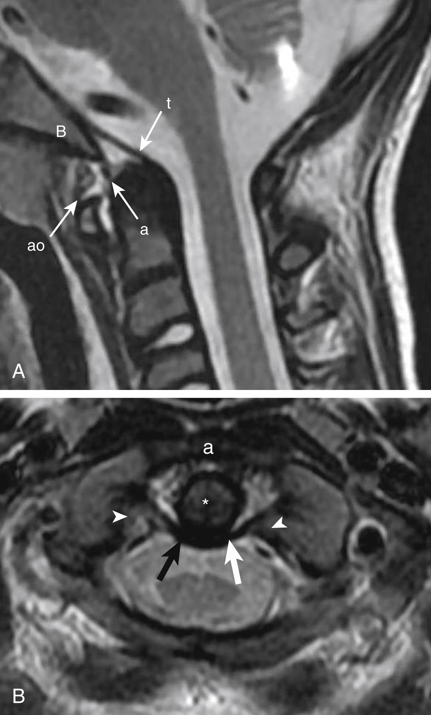 Fig. 28.11, Craniocervical junction ligaments.