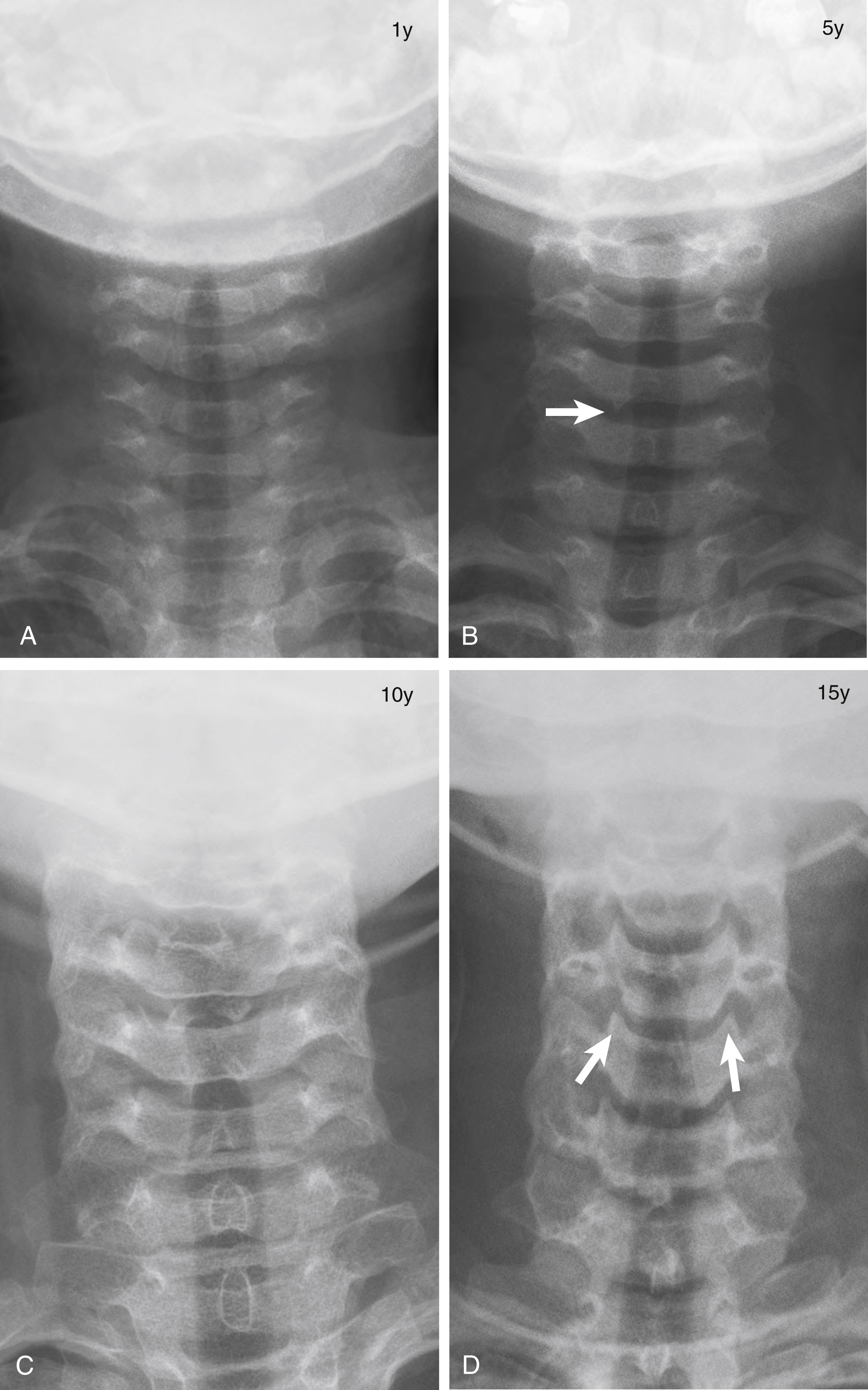 Fig. 28.2, Anteroposterior radiographs of the cervical spine at (A) 1, (B) 5, (C) 10, and (D) 15 years of age. Vertebral body joints are shallow in the young child (B) ( arrow ). There is development of the uncovertebral joints in the older child ( arrows ) (D).