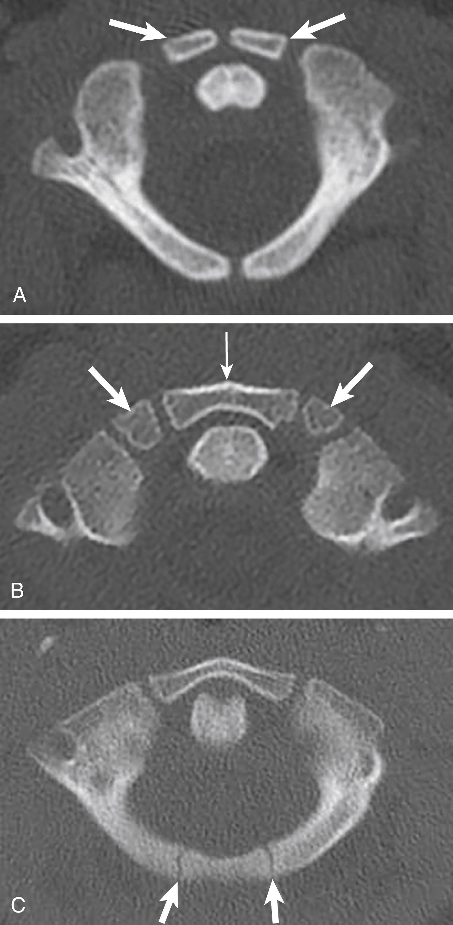 Fig. 28.4, A few examples of C1 anterior arch ossification variants.