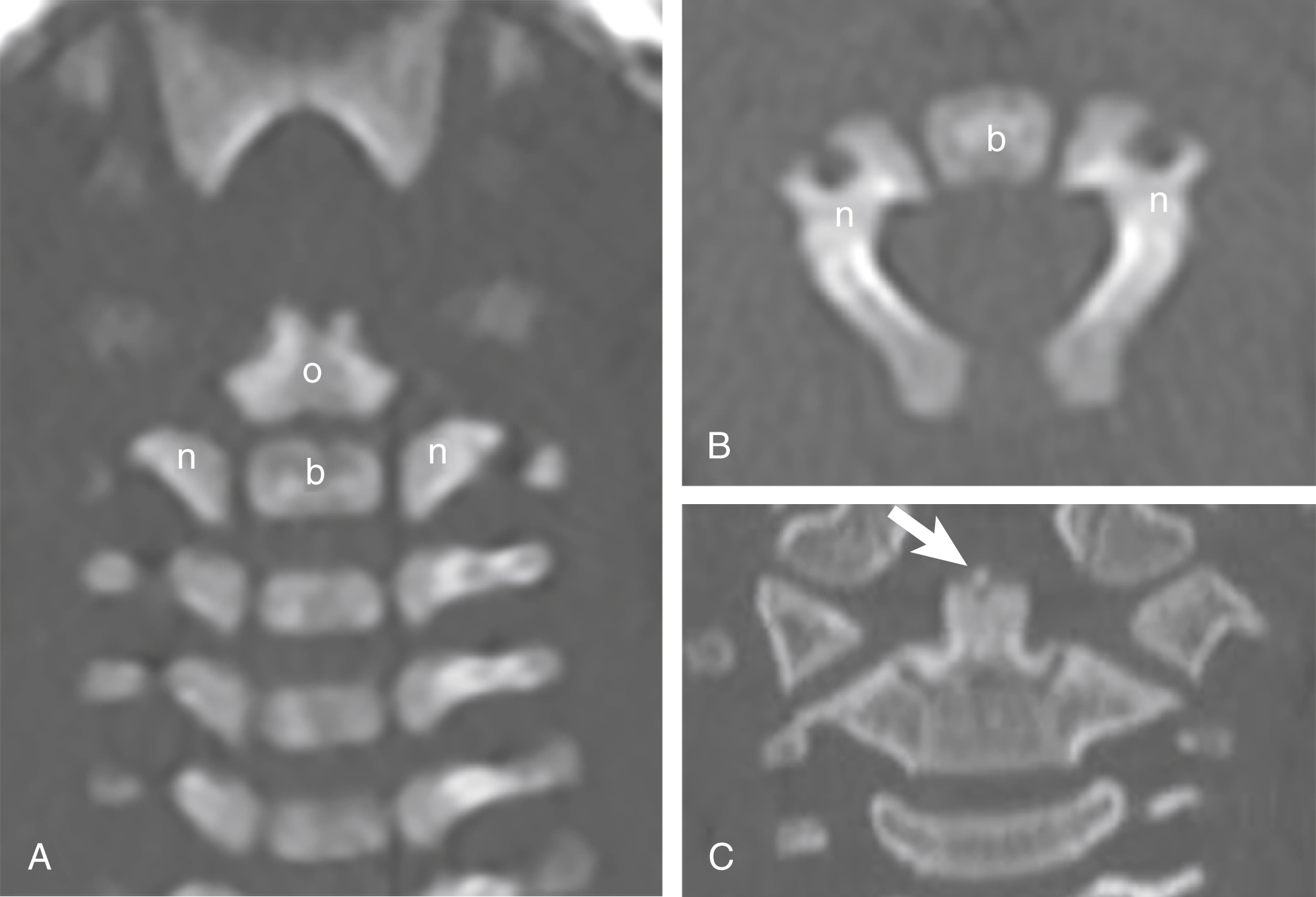 Fig. 28.5, C2 development in a 1-month-old infant.