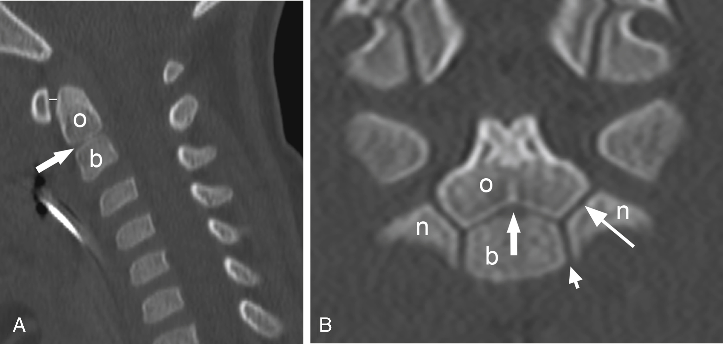 Fig. 28.6, C2 synchondroses in a 3-year-old.