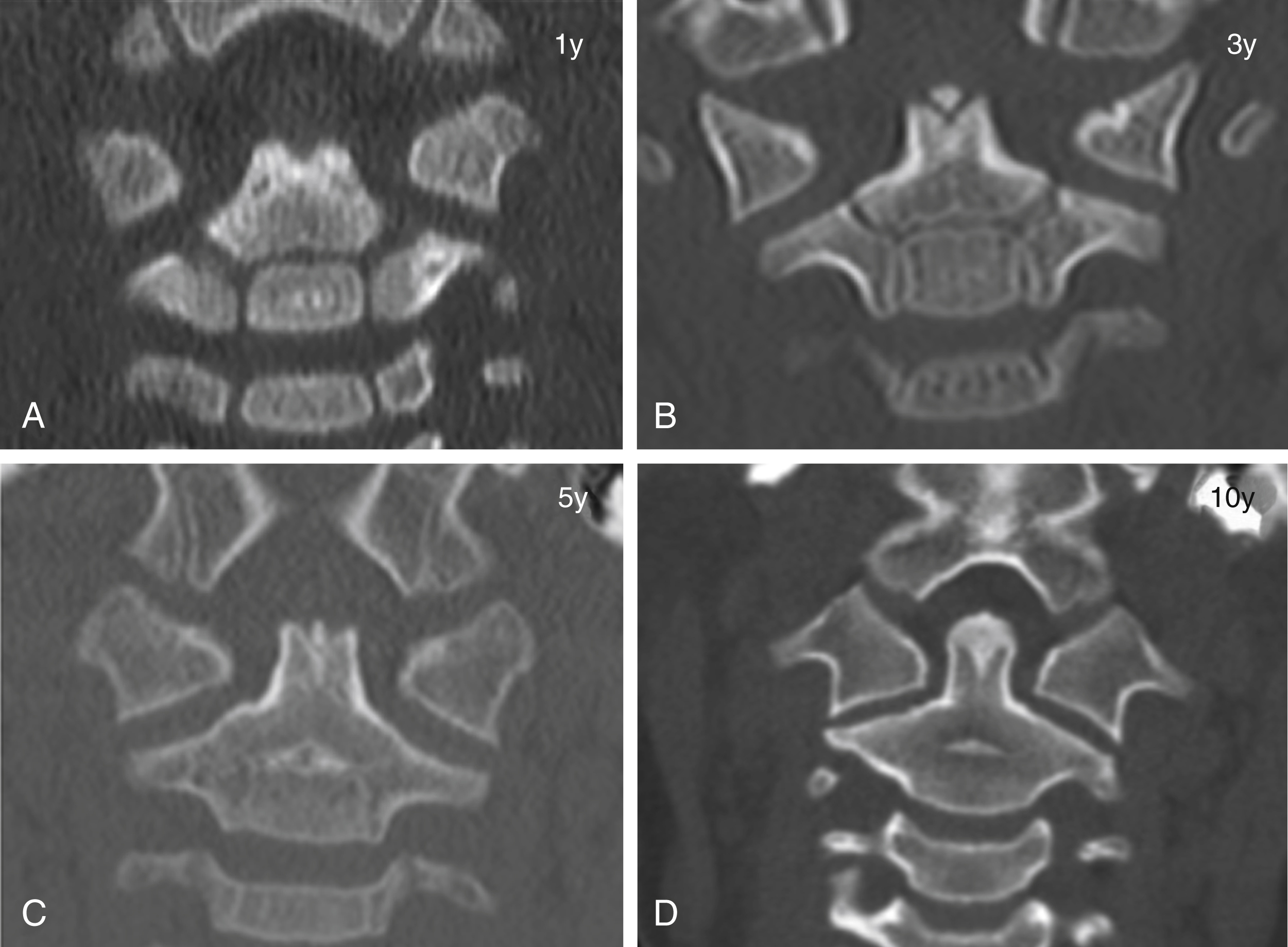 Fig. 28.7, Closure of C2 synchondroses.