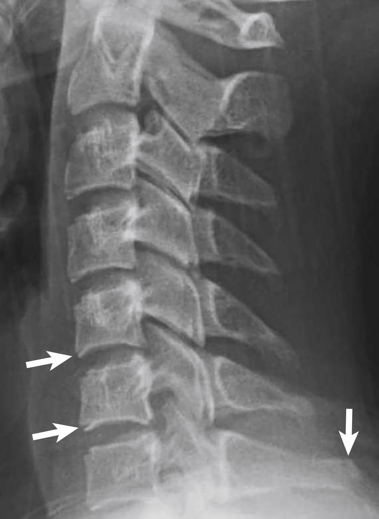 Fig. 28.9, Cervical spine apophyses.