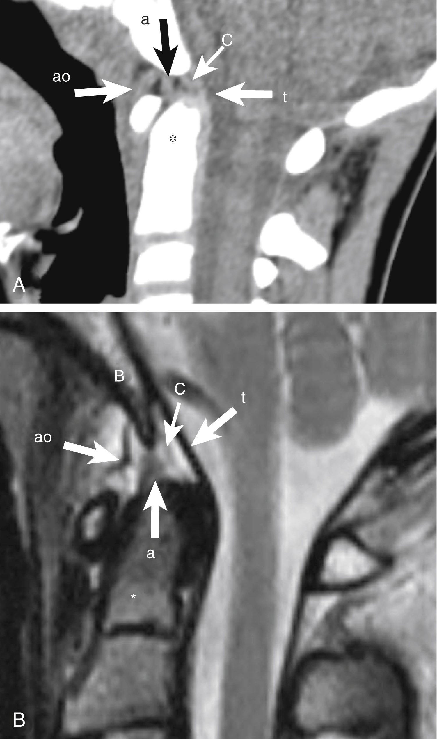 Fig. 28.10, Craniocervical junction ligaments.