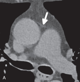 Figure 38.1, Normal pericardium on CT. Axial images at the level of the ascending aorta (A), main pulmonary artery (B), aortic root (C), and coronary sinus demonstrates a curvilinear band of soft tissue surrounding the heart from the level of the great vessels to the diaphgragm (arrows). (D) The pericardium is best visualized when outlined by epicardial (E) and mediastinal (T) fat (arrows) . Although the entire pericardium is often difficult to visualize, it is almost always present. Up to 35 mL of fluid is normally found in the pericardial sac, and it is important not to confuse a small amount of physiologic fluid ( asterisk, C) with pericardial thickening.