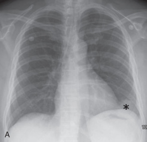 Figure 38.11, Incidental finding of a pericardial cyst on preoperative radiograph in a 33-year-old man. Posteroanterior (A) and lateral (B) radiographs demonstrate a rounded mass (asterisks) at the left cardiophrenic angle, which contacts both the diaphragm and chest wall. (C) Coronal CT shows a round cyst (asterisk) contiguous with the pericardium. The lesion shows homogenous internal fluid attenuation , without internal enhancement or soft tissue attenuation.