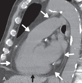 Figure 38.2, Normal pericardium on CT. A 5-mm thick ray-sum parasaggital image of the thorax (A) and 8-mm thick ray-sum short-axis image through the base of the left ventricle (B) show the extend of the pericardium, which encloses the heart (white arrows). Although portions of the pericardium are not well seen, such as that along the diaphragmatic surface ( black arrow , A), the pericardium is present. Fluid is normally present in the pericardium ( asterisk, A) and should not be confused with pathologic thickening.