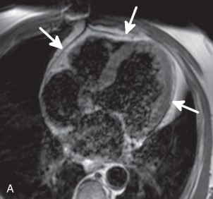 Figure 38.3, Normal appearance of pericardium on MRI. Four-chamber T1-weighted (A) and T2-weighted (B) images in a 68-year-old man and a three-chamber image from a steady-state free precession image (C) in a 57-year-old man show a normal pericardium, which is isointense to hypointense to adjacent myocardium (arrows) on all sequences. Similar to CT, the pericardium is best seen when outlined by hyperintense mediastinal fat. An apical aneurysm from a prior left anterior descending infarct ( asterisk, C) can also be seen.