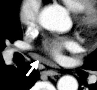 Figure 38.4, Axial CT image in a 44-year-old man demonstrates fluid in the oblique sinus (arrow), which is located posterior to the left atrium.