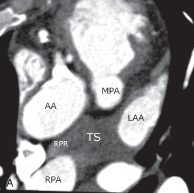 Figure 38.5, Fluid in the transverse sinus extending in the pulmonary recesses in a 59-year-old woman. (A) Axial oblique images show fluid in the transverse sinus (TS), which is located between the ascending aorta (AA), main pulmonary artery (MPA), and left atrial appendage (LAA). The TS is contiguous with fluid in the right pulmonary recess (RPR), which is inferior to the right main pulmonary artery (RPA). (B) More superior axial image shows fluid in the left pulmonary recess (LPR), which is contiguous with the TS and is inferior to the left pulmonary artery. Fluid is also present in the anterior portion of the superior aortic recess (ASAR).