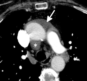 Figure 38.6, Fluid in the superior aortic recess in a 65-year-old man with lung cancer. This axial image at the level of the left pulmonary artery shows crescentic fluid in the anterior portion (arrow) and posterior portion (asterisk) of the superior aortic recess. Fluid in this location is common and should not be confused with adenopathy or other pathology.