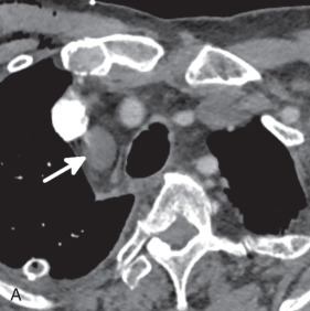 Figure 38.7, A 42-year-old man with high-riding superior pericardial recess mimicking a mediastinal cyst. (A) Axial image at the level of the aortic arch vessels shows a cystic mass in the right paratracheal region (arrow). (B) Sagittal image shows that this fluid collection (arrow) communicates with the posterior (asterisk) and anterior (arrowhead) aspects of the superior aortic recess, consistent with a high-riding superior aortic recess. This anatomic variant can be easily confused with a mediastinal cystic mass, which could lead to unnecessary intervention.