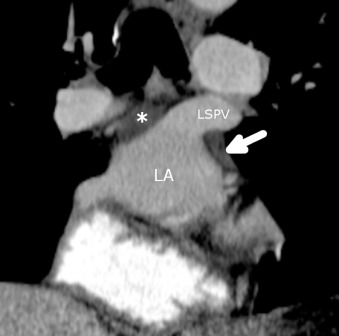 Figure 38.8, Coronal oblique multiplanar reformat demonstrates fluid in the left pulmonary venous recess (arrow), which is located between the left superior pulmonary vein (LSPV) and left inferior pulmonary vein. A small amount of fluid is also seen in the superior aspect of the oblique sinus (asterisk). LA, Left atrium.