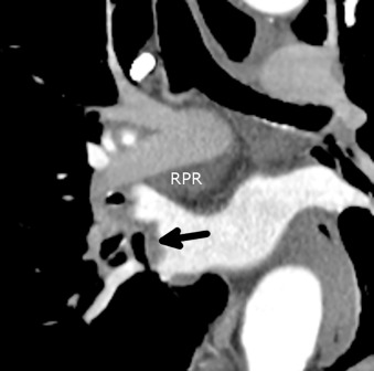 Figure 38.9, Coronal image in a 45-year-old woman with an aortic aneurysm shows fluid in the right pulmonary venous recess (arrow) between the right superior and inferior pulmonary veins. Fluid is also present in the right pulmonary recess (RPR), inferior to the right pulmonary artery.