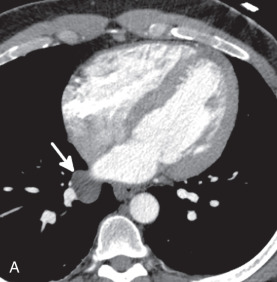 Figure 38.10, Axial oblique (A) and sagittal oblique (B) multiplanar reformats show fluid in a serosal sleeve (arrows) that surrounds the right inferior pulmonary vein ( asterisk, B) in a 26-year-old man. This collection has a characteristic appearance and should not be confused with a mass or adenopathy.