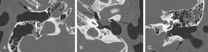 Fig. 10.1, Postoperative appearance of the external auditory canal (EAC). (A) Axial CT with absence of the normal bony isthmus ( white arrows ) and a foreshortened anterior wall ( black arrow ) from bone drilling. (B) Axial CT, defect in the anterior wall of the EAC (between black arrows ) is covered by scar. (C) Coronal CT, flaring of the EAC from medial to lateral, which appears patulous laterally (between black arrows ) after combined meatoplasty/canaloplasty.