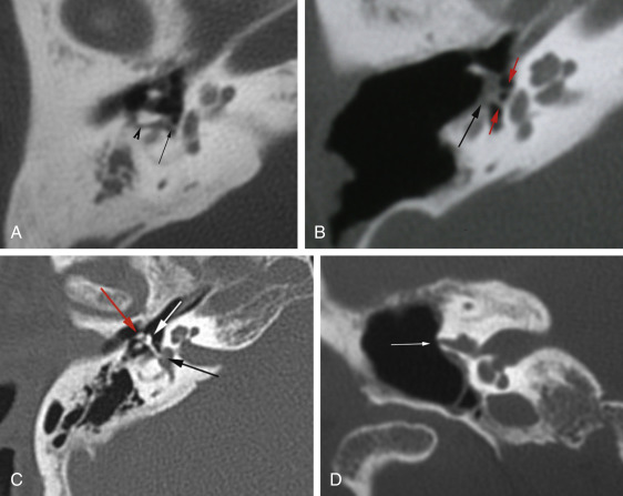 Fig. 10.2, Tympanoplasty types. (A) Type 2—axial CT, incus interposition ( arrowhead ) to intact stapes ( arrow ). (B) Type 3—axial CT, tympanic membrane (TM)/graft ( black arrow ) in contact with intact stapes ( red arrows ). (C) Type 4—axial CT, absent stapes superstructure, mobile footplate. Prosthesis cupped laterally ( white arrow ) around malleus remnant ( red arrow ) to stapes footplate ( black arrow ). (D) Type 5—coronal CT, patient post bilateral type 5 tympanoplasty in the late 1950s, right side shown. Fenestration of the horizontal canal ( white arrow ), TM/graft applied against the fenestration is thin and not well seen by CT.