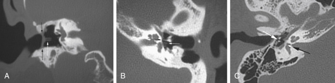 Fig. 10.3, Displaced prostheses. (A) Partial ossicular replacement prosthesis (PORP) ( white arrow ) based on the deep margin of the thickened tympanic membrane/graft ( black arrows ) is lateralized with the graft; tip of the PORP is well away from the oval window/stapes. (B) Tip of an incus interposition ( black arrow ) is displaced anterior to the stapes capitulum ( white arrow ). (C) Piston-type prosthesis after stapedectomy is displaced deep into the vestibule, the tip against the medial margin (black arrows). There was no identifiable connection to the incus (white arrow) by CT.