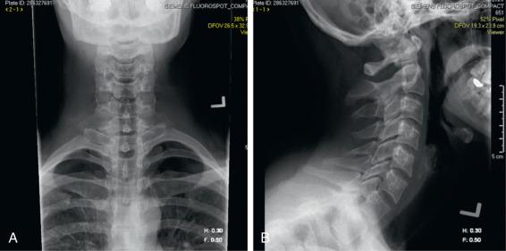 Fig. 124.1, Anteroposterior (A) and lateral (B) radiographs of the C spine at a neutral position showing normal lordosis.