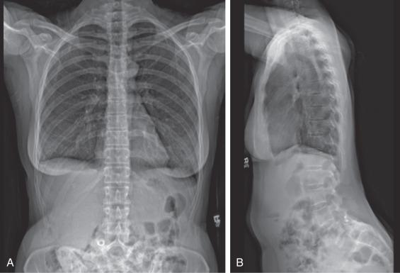 Fig. 124.2, EOS 2D/3D can produce complete anteroposterior (A) and lateral (B) images of the axial skeleton with one shot. Note that compared to the image quality of x-ray images in Fig. 124.1 , EOS 2D/3D images are very similar.