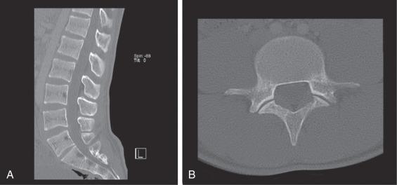 Fig. 124.3, Sagittal reconstructed (A) and axial computed tomography (B) images through L-Spine. The soft tissue is poorly differentiated but bony structures are visualized with great detail.