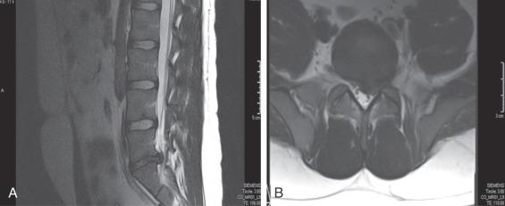 Fig. 124.4, Sagittal (A) and axial (B) T2 magnetic resonance imaging images show the soft tissue structures in the lumbar spine. Notably, disc herniation can be appreciated at the L5-S1 disc. The axial image shows that the disc herniates more towards the right than the left.