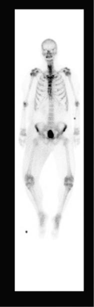 Fig. 124.5, DEXA scan in a 52-year-old male shows the increased signal intensity in regions with higher uptake of the radioisotope, notably the pelvic rim, physeal plate of the distal femur, proximal radius, and shoulder region. The radioisotope is cleared by the kidneys and hence the increased uptake in the bladder.