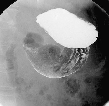 Figure 19-3, Left anterior oblique view.