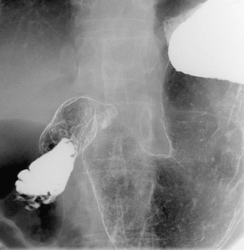 Figure 19-4, Duodenal view.