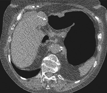 Figure 19-5, Computed tomography with air contrast within the stomach demonstrating the axial configuration (arrows).