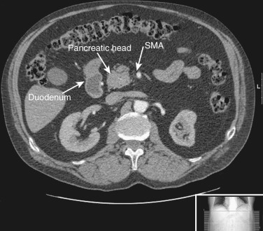 Figure 19-6, Axial computed tomography through the second part of the duodenum. SMA, Superior mesenteric artery.