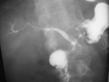 Figure 19-8, Note that the biliary tree is opacified, suggesting fistulation with a duodenal ulcer.